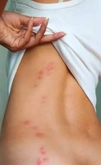 ي حشرة الفراش.  #البق أو كما تسمي (حشرة البق)