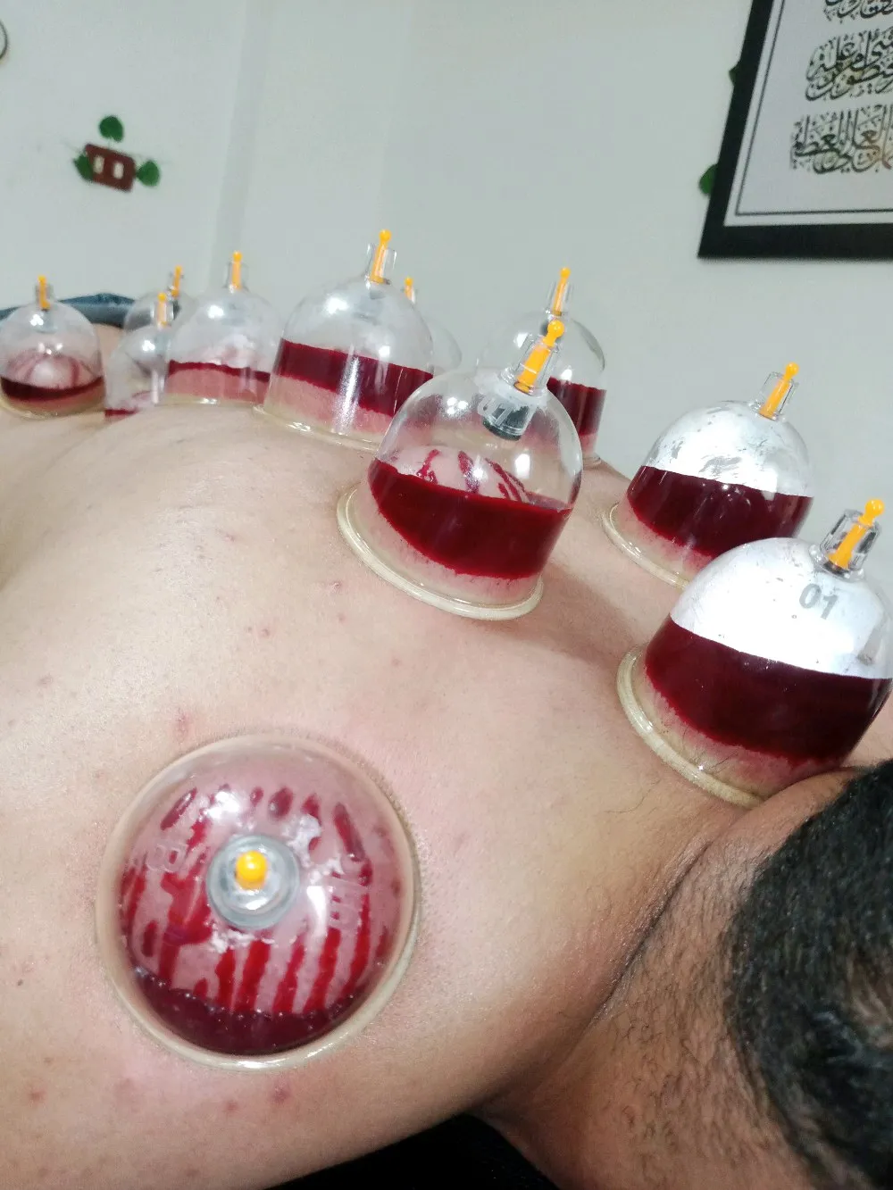 حجامة بأنواعها كايروبرايتيك شياتسو مصل النحل رقية شرعية