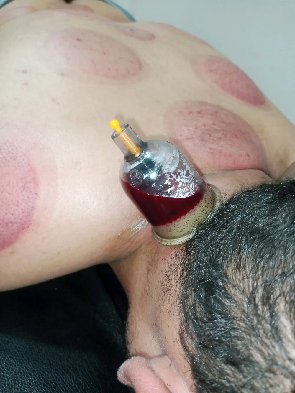 حجامة بأنواعها كايروبرايتيك شياتسو مصل النحل رقية شرعية