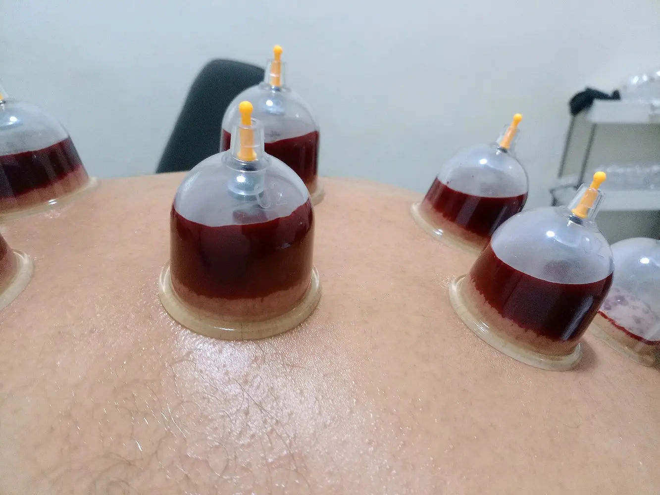 أبن جُبران للحجامة والمساجي العلاجي والاسترخائي