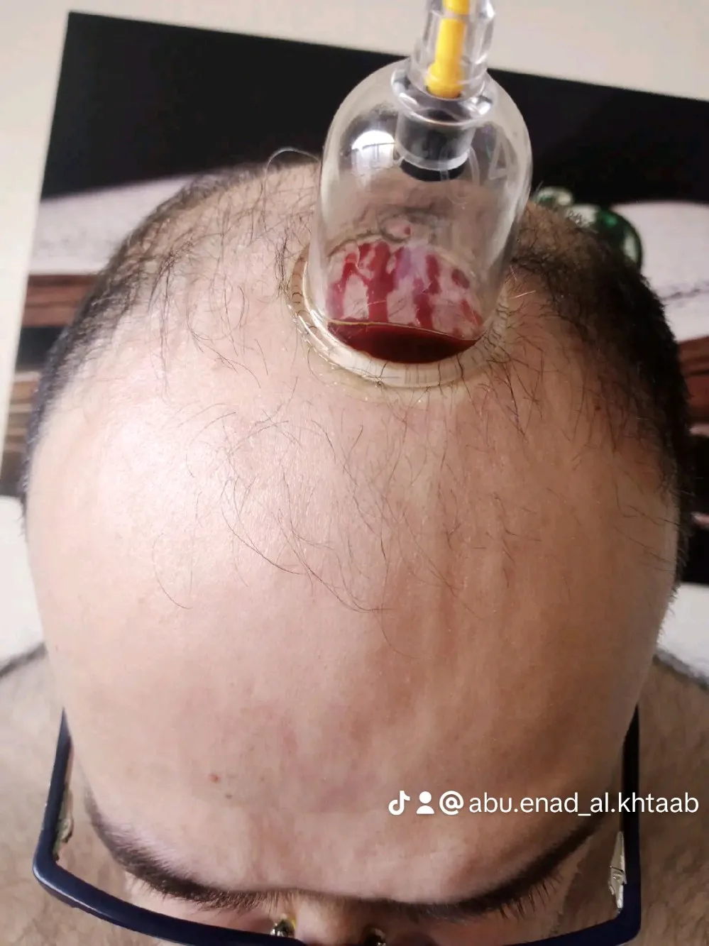 حجامة بأنواعها كايروبرايتيك شياتسو مصل النحل رقية شرعية