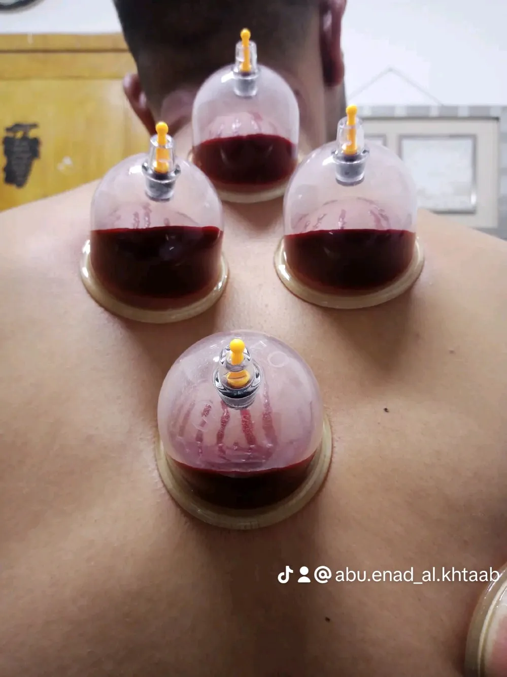 حجامة بأنواعها كايروبرايتيك شياتسو مصل النحل رقية شرعية