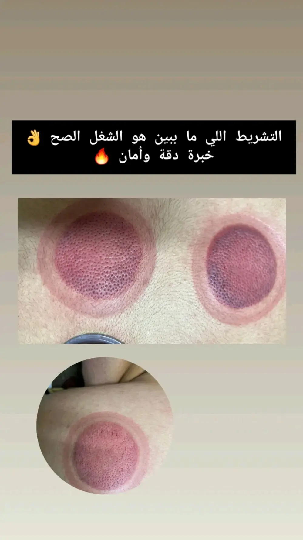 حجامه علاجيه وقائيه