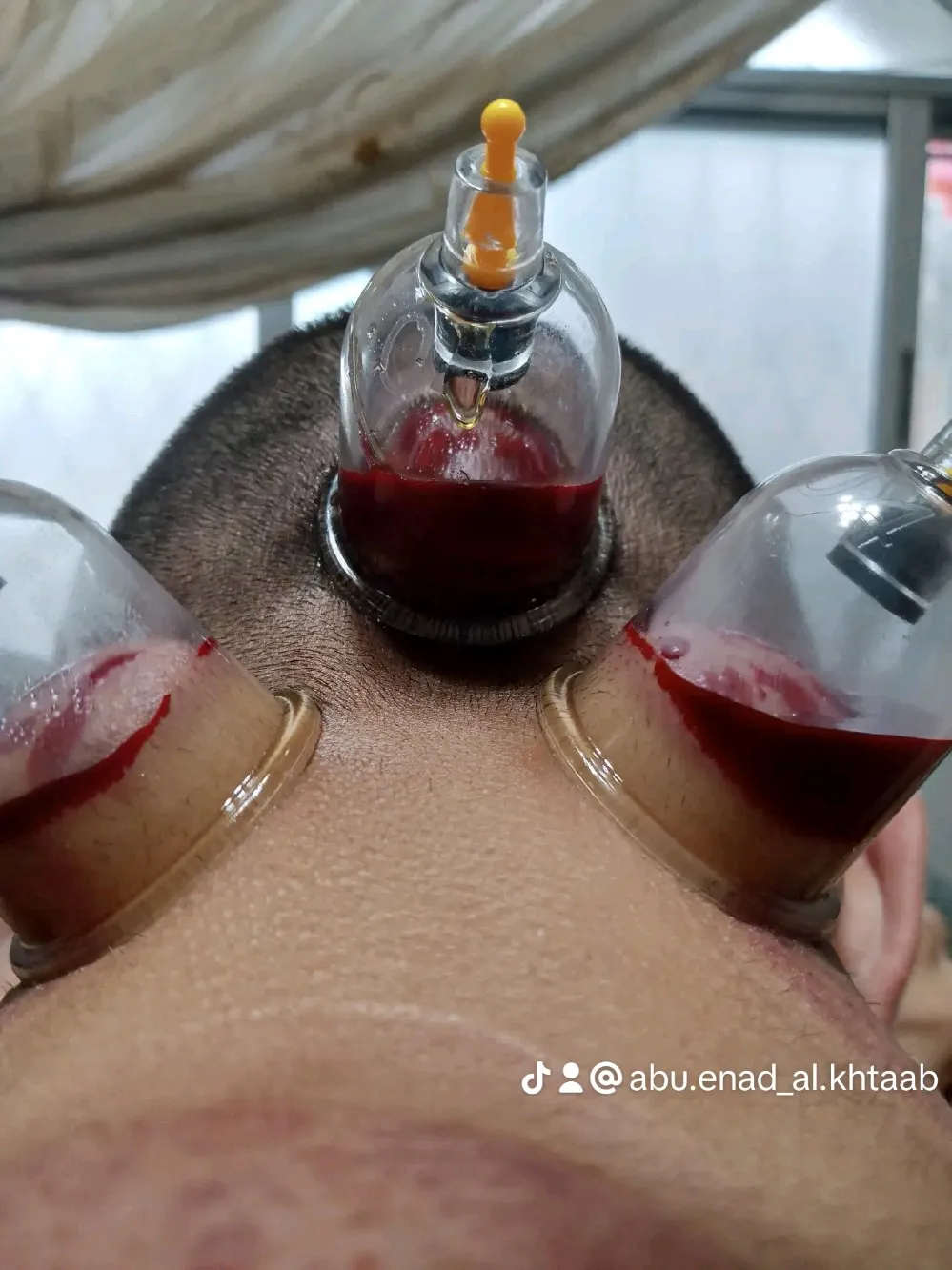 حجامة بأنواعها كايروبرايتيك شياتسو مصل النحل رقية شرعية