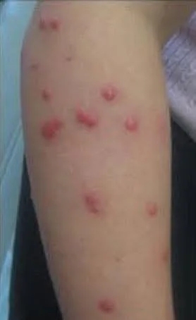 ي حشرة الفراش.  #البق أو كما تسمي (حشرة البق)