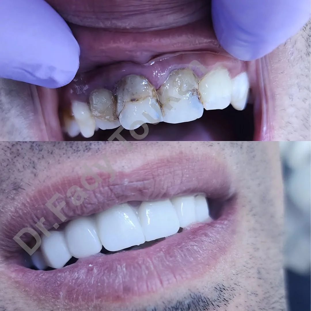 تركيبات الزيىكون