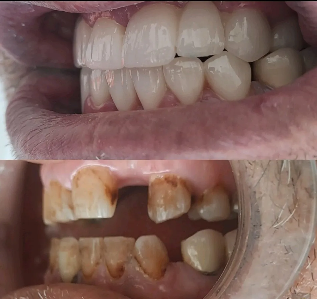 Zirconia crwan