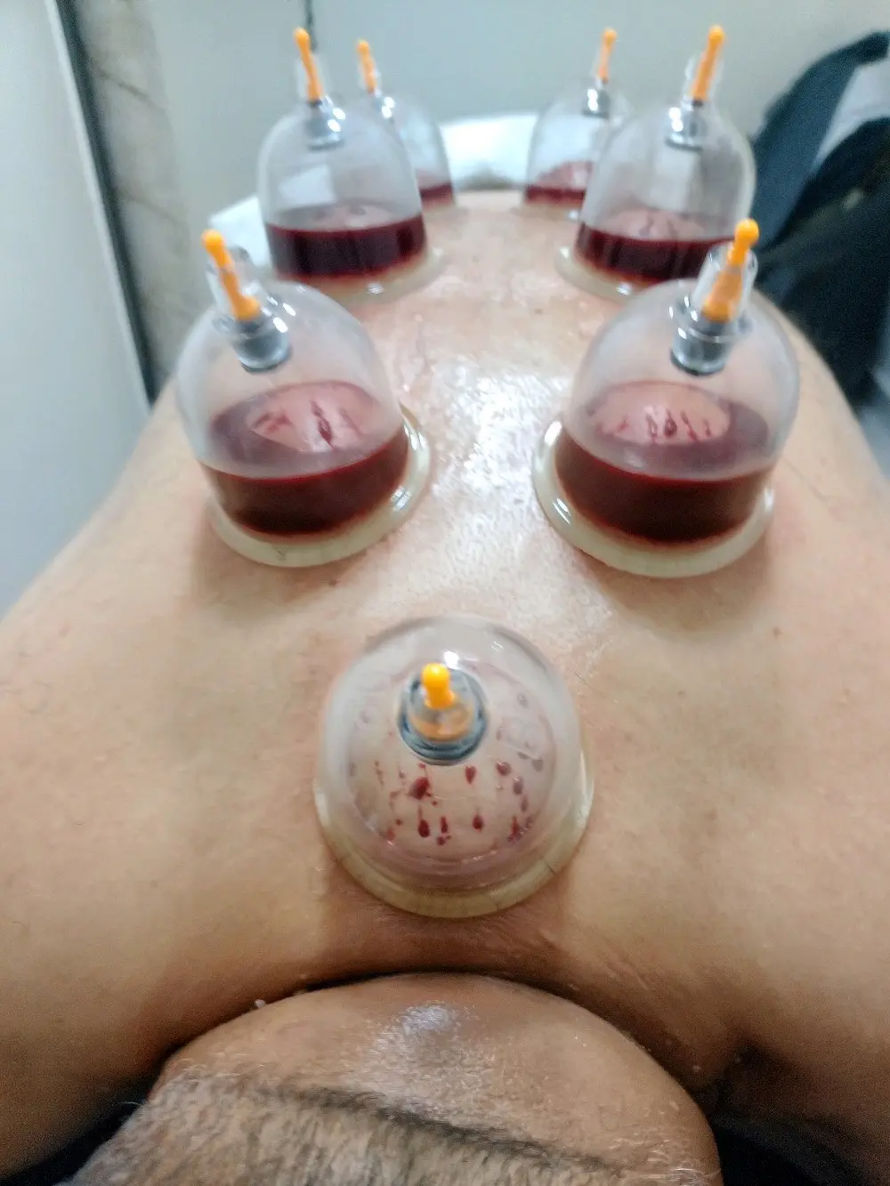 أبن جُبران للحجامة والمساجي العلاجي والاسترخائي